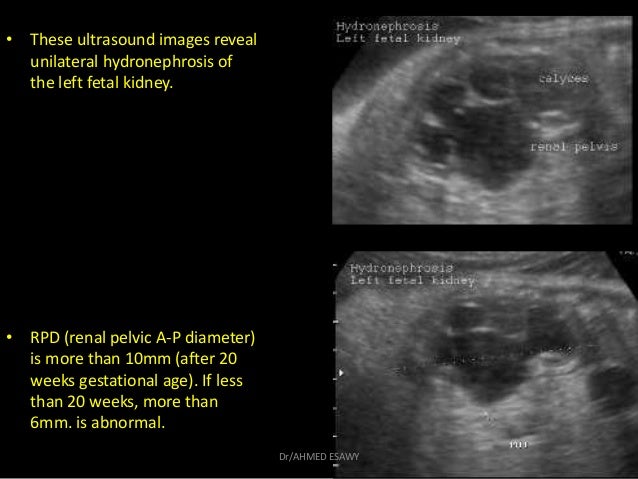 fetal renal penises Breast skewering pussy sewing